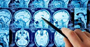 déficits cognitivos, colesterol cerebral, parkinson