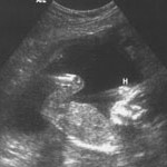 baby ultrasound