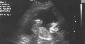 baby ultrasound