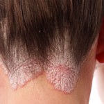 psoriasis