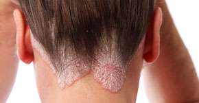psoriasis