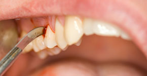 dental treatment