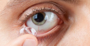 Application of contact lens