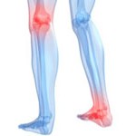tratamiento de la artrosis de rodilla