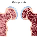 osteoporosis