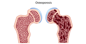 osteoporosis